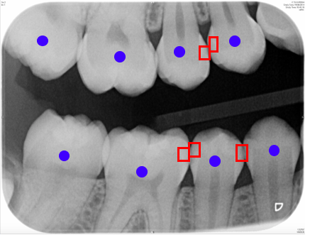 bitwing X-ray showing areas where further investigation is advised